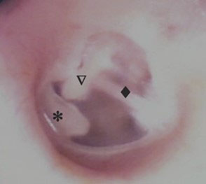Eardrum 2